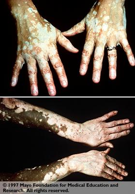 Vitiligo.jpg