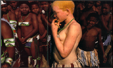 albino person delineation