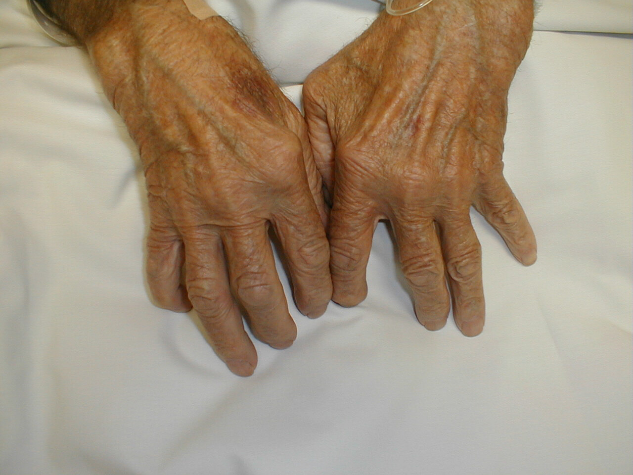 Hands of a person suffering from rheumatoid arthritis