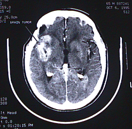 a brain tumor :( - Cheap