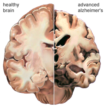 Alzheimer's Disease Alzheimer's Disease