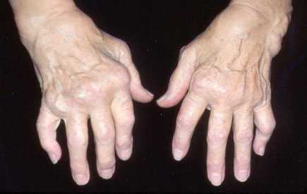 The hand in rheumatoid arthritis.