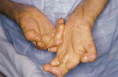 to multibacillary leprosy