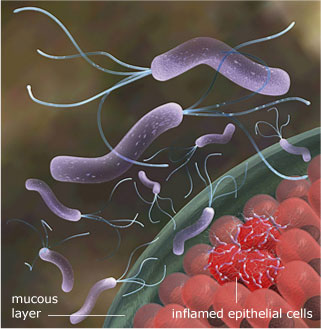 helicobacter pylori depiction