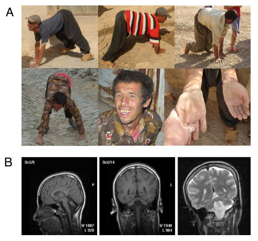 Unertan Syndrome Phenotype