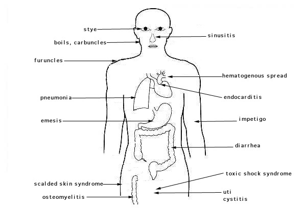 Mrsa sites of infection