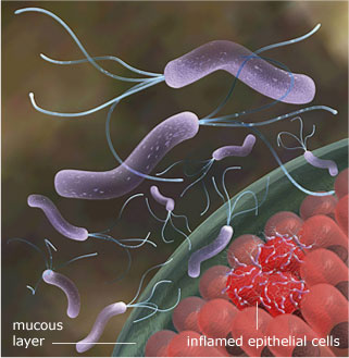 helicobacter pylori